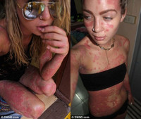 Người đẹp “quái vật” tự tin khoe cơ thể 97% là vẩy nến ảnh 5 Người đẹp “quái vật” tự tin khoe cơ thể 97% là vẩy nến ảnh 5