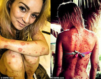 Người đẹp “quái vật” tự tin khoe cơ thể 97% là vẩy nến ảnh 4 Người đẹp “quái vật” tự tin khoe cơ thể 97% là vẩy nến ảnh 4