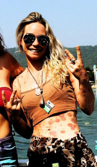 Người đẹp “quái vật” tự tin khoe cơ thể 97% là vẩy nến ảnh 2 Người đẹp “quái vật” tự tin khoe cơ thể 97% là vẩy nến ảnh 2