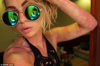 Người đẹp “quái vật” tự tin khoe cơ thể 97% là vẩy nến ảnh 3 Người đẹp “quái vật” tự tin khoe cơ thể 97% là vẩy nến ảnh 3