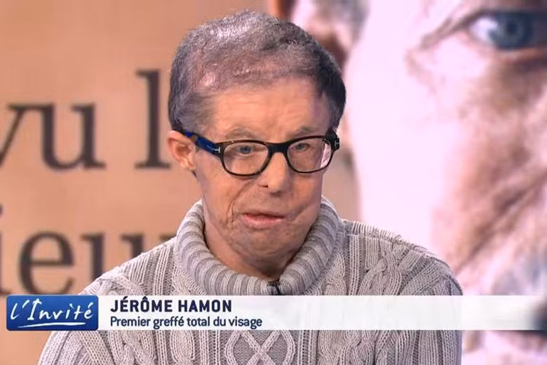 Ông Jerome Hamon là người đầu tiên trải qua hai cuộc phẫu thuật ghép mặt. Ảnh: Strait Times.
