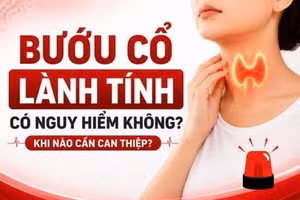 Bướu cổ lành tính có nguy hiểm không? Khi nào cần can thiệp?