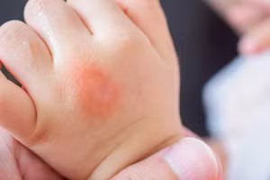 Muỗi thích những người có thể chất có tính axit. (Ảnh: ITN)