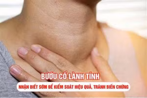 Tuyến giáp phì đại gây bướu cổ lành tính