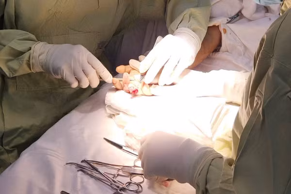 Các bác sĩ thực hiện cấp cứu vi phẫu khẩn cấp bảo tồn ngón tay cho bệnh nhân. 