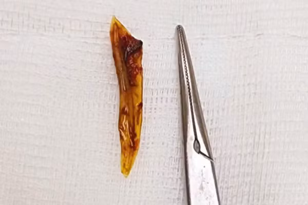 Hình ảnh xương cá gây thủng ruột cụ ông. (Ảnh: BVCC)