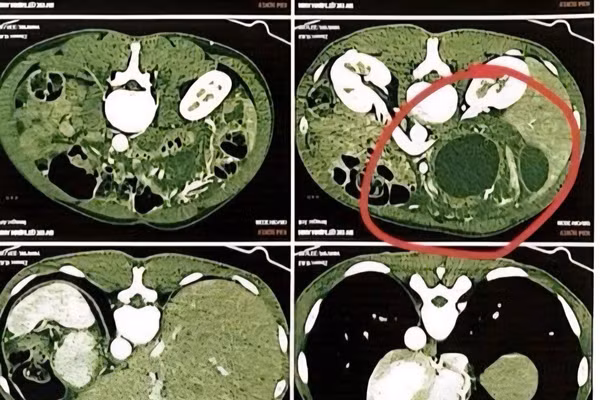 Hình ảnh phim chụp CT scan ổ bụng của bệnh nhân T.K. 