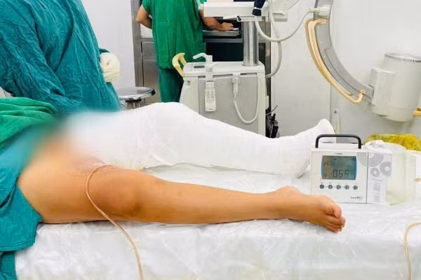Sau mổ, chân bé được cố định bằng nẹp bột tư thế duỗi thẳng.