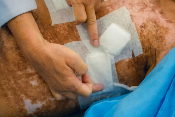 Bệnh nhân T. từng bị bỏng 60% cơ thể cách đây 6 năm.