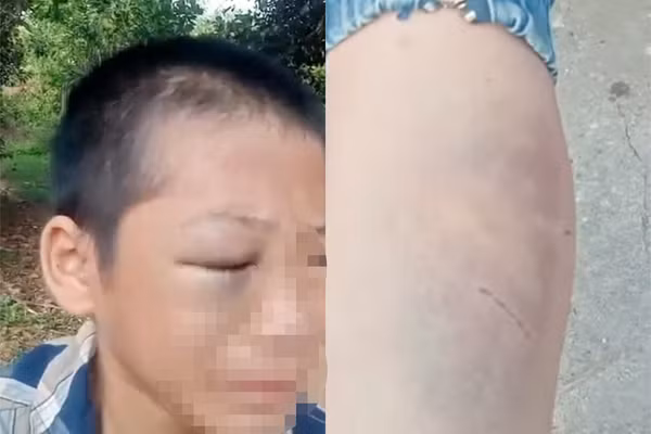 Bé trai bị nhiều vết bầm tím trên cơ thể. (Ảnh cắt từ clip)