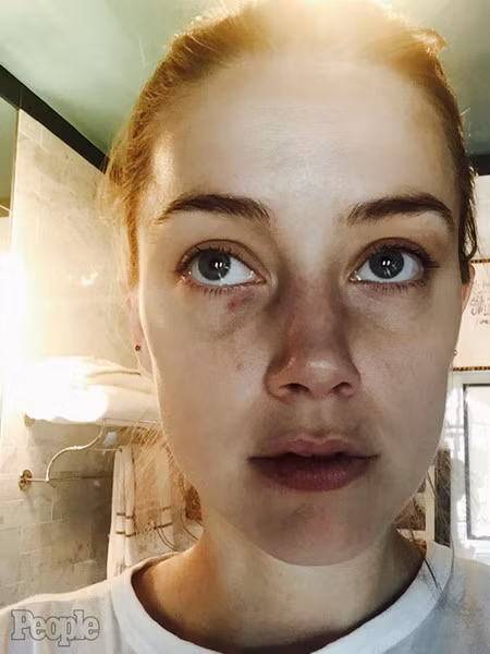 amber heard tung thêm ảnh bằng chứng tố johnny depp bạo hành hình 3 amber heard tung them anh bang chung to johnny depp bao hanh hinh 3