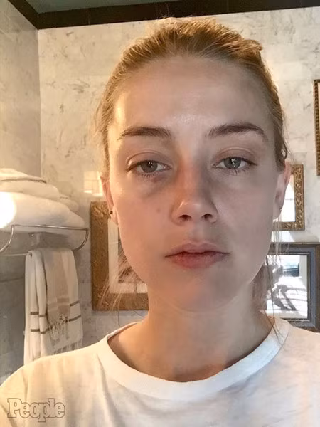 amber heard tung thêm ảnh bằng chứng tố johnny depp bạo hành hình 1 amber heard tung them anh bang chung to johnny depp bao hanh hinh 1
