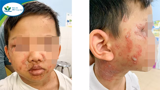 Nguồn: BV Nhi Trung ương.