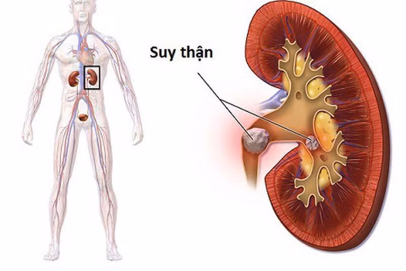 Suy thận là căn bệnh vô cùng nguy hiểm. Ảnh minh hoạ. Suy thận là căn bệnh vô cùng nguy hiểm. Ảnh minh hoạ.