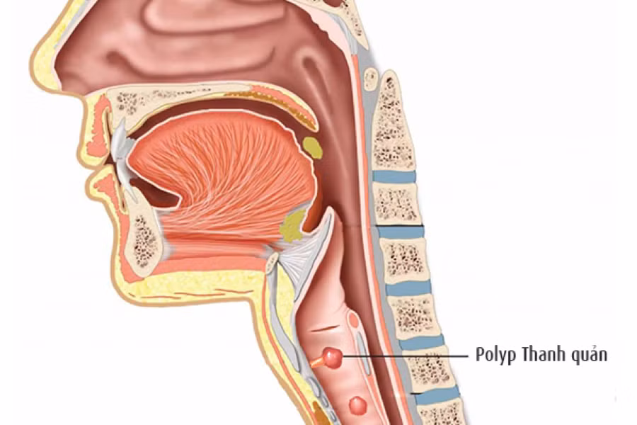 Polyp dây thanh sẽ gây khàn tiếng kéo dài.