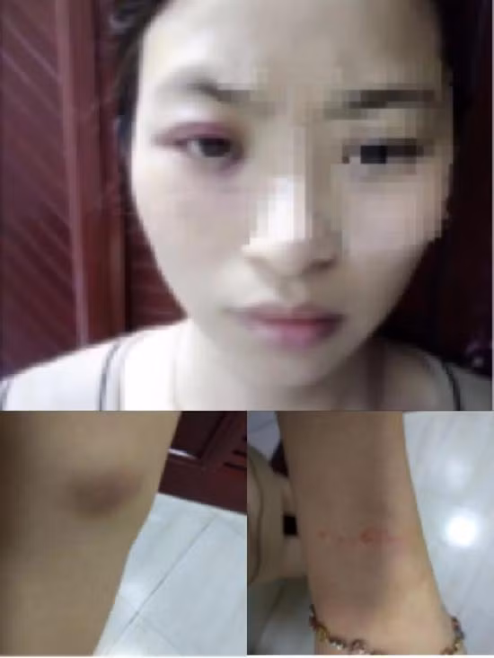 Bức ảnh Hiểu Linh với thương tích vì bạo hành được người nhà chụp lại. Ảnh: Sina. Gui tin nhan cho ban truoc khi bi danh tu vong hinh anh 1