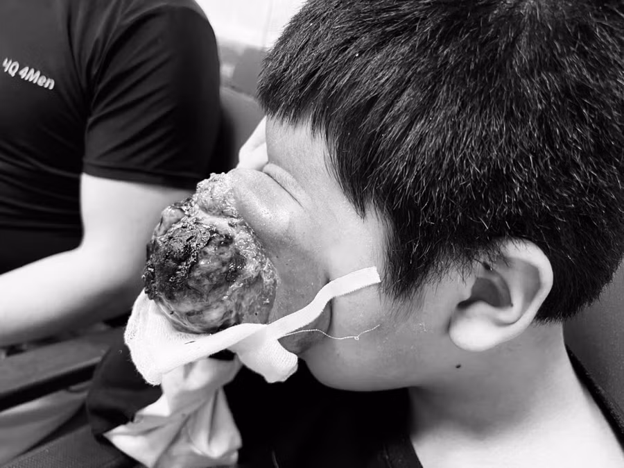 Khối u ở mắt trái bé trai. Ảnh: BV.