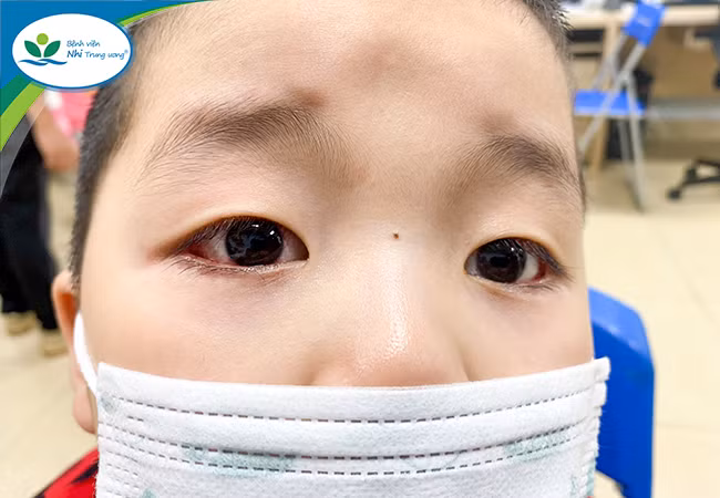 Trẻ bị viêm kết mạc hậu Covid-19 được khám và chẩn đoán tại Khoa Mắt – Bệnh viện Nhi Trung ương. Nguồn: BV Nhi Trung ương.