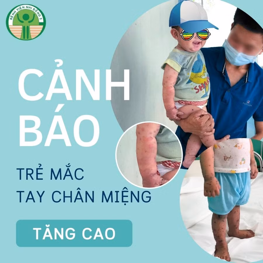 Việc cần làm ngay khi phát hiện trẻ mắc tay chân miệng ảnh 1