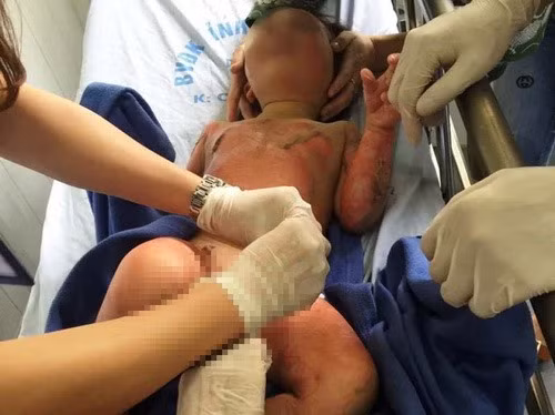 Một trẻ bị bỏng được các bác sỹ Bệnh viện Đa khoa tỉnh Hà Nam cấp cứu. Ảnh: Dân trí