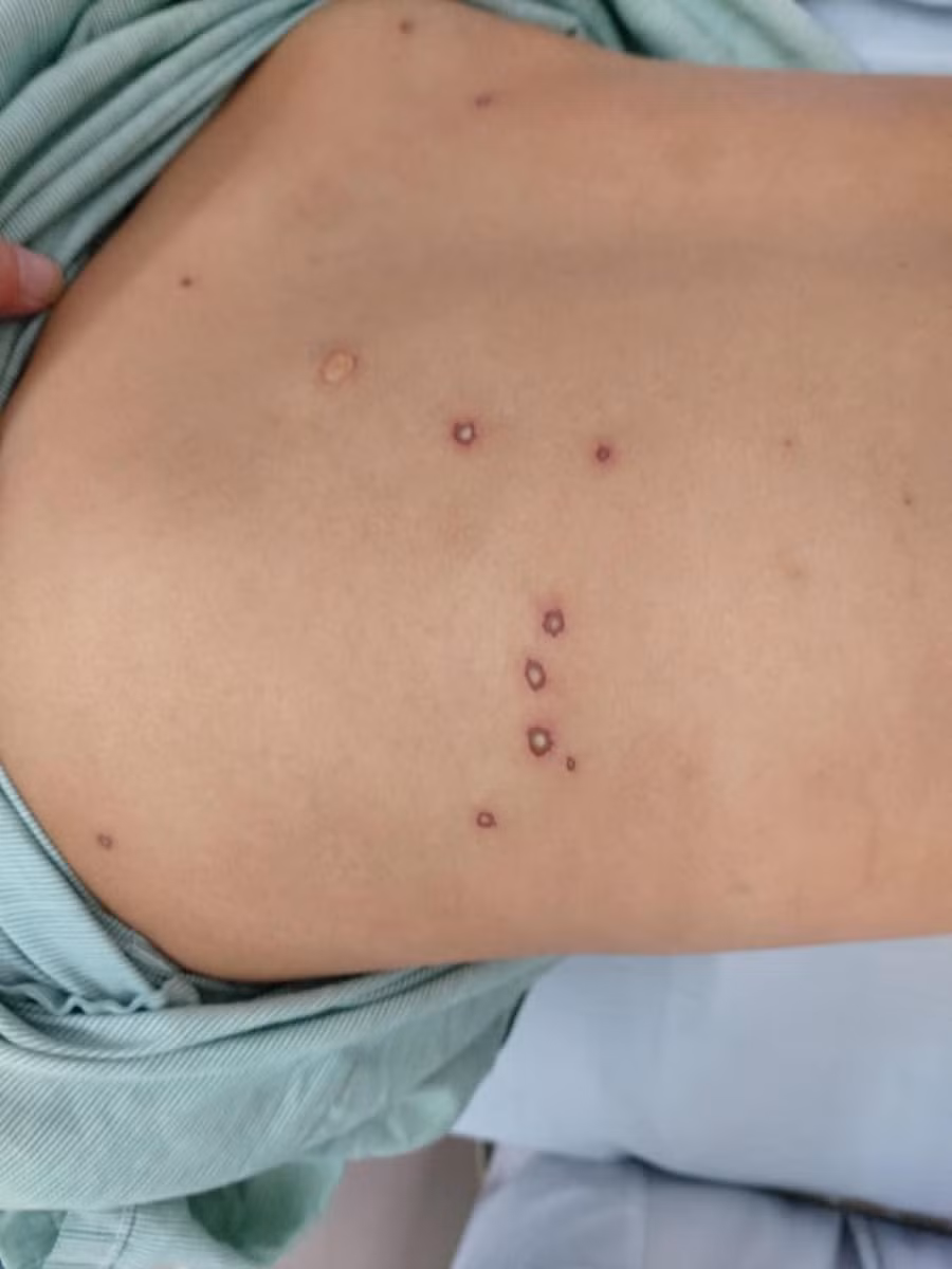 Bệnh nhân bị ong vò vẽ đốt khoảng 70 nốt. Ảnh: TTYT Tiên Yên. Bệnh nhân bị ong vò vẽ đốt khoảng 70 nốt. Ảnh: TTYT Tiên Yên.