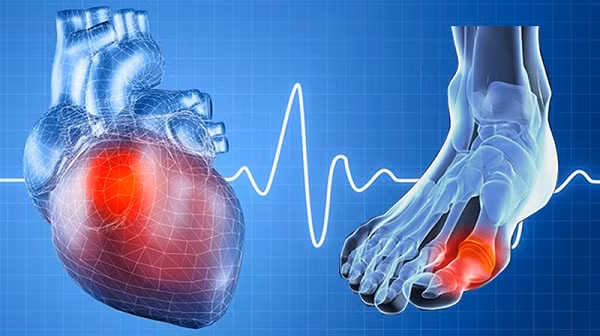 Bệnh gút gây biến chứng nguy hiểm, ảnh hưởng tới huyết áp, tim mạch, thận… Ảnh: ITN