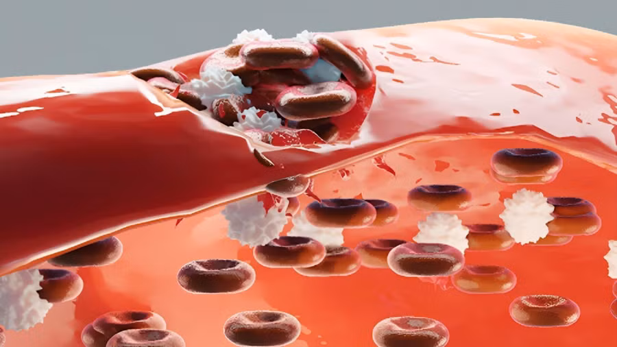 Hemophilia là tên gọi chuyên môn của bệnh ưa… chảy máu - bệnh chỉ gặp ở nam giới mà không gặp ở nữ giới. Ảnh minh họa.