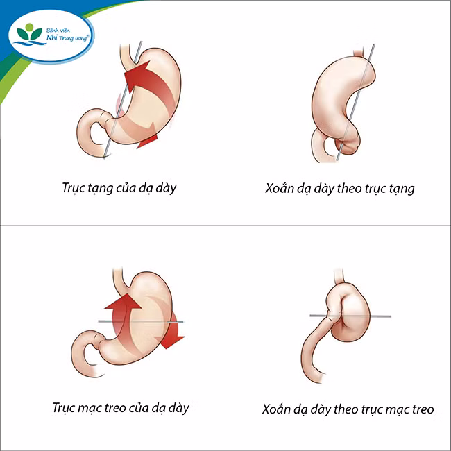 Hình ảnh xoắn dạ dày theo trục tạng và trục mạc treo. Hình ảnh xoắn dạ dày theo trục tạng và trục mạc treo.