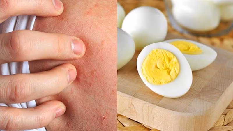 Vì sao bị dị ứng khi ăn trứng?