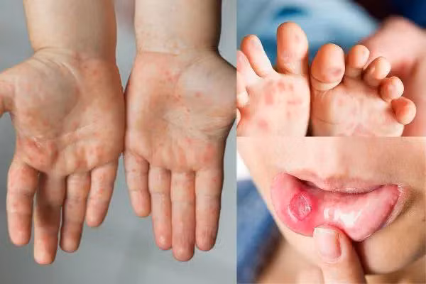 Hai nhóm tác nhân gây bệnh tay chân miệng thường gặp là Coxsackie virus A16 (CA16) và Enterovirus 71 (EV71). Ảnh minh hoạ.
