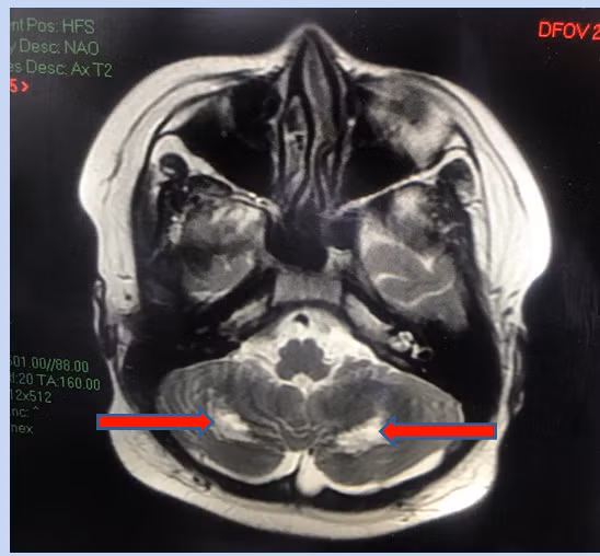 Hình ảnh cộng hưởng từ (MRI) não của bé T.G.H. (13 tuổi) cho thấy tổn thương chất trắng vùng tiểu não hai bên, gây hiện tượng rối loạn phối hợp vận động, loạng choạng... Ảnh: BV.
