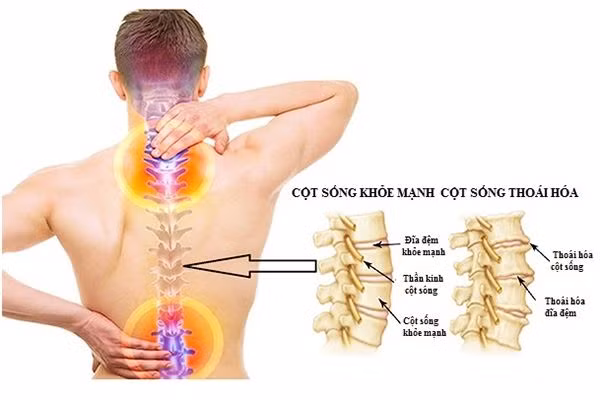 Thoái hoá cột sống cũng gây đau dây thần kinh liên sườn.