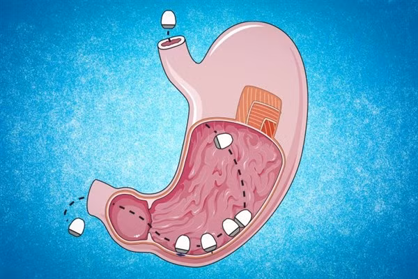 Các nhà nghiên cứu của MIT đã thiết kế một viên nang có thể tự gắn vào niêm mạc dạ dày và tiêm RNA sau khi được uống vào.