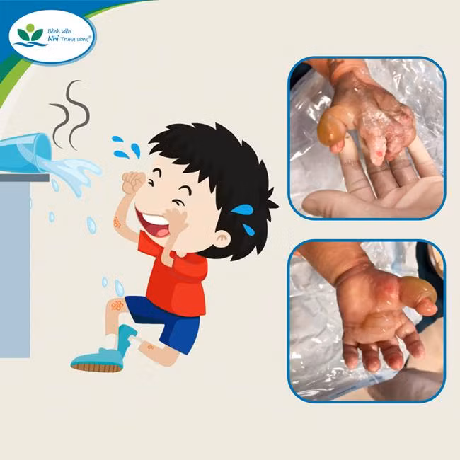 Hình ảnh bỏng nước sôi và di chứng sau bỏng ở trẻ em. Ảnh: Bác sĩ cung cấp. Hình ảnh bỏng nước sôi và di chứng sau bỏng ở trẻ em. Ảnh: Bác sĩ cung cấp.