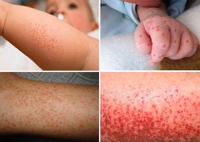 Da trẻ xuất hiện nốt xuất huyết là dấu hiệu dễ nhận thấy khi bị sốt xuất huyết. Ảnh: BV.