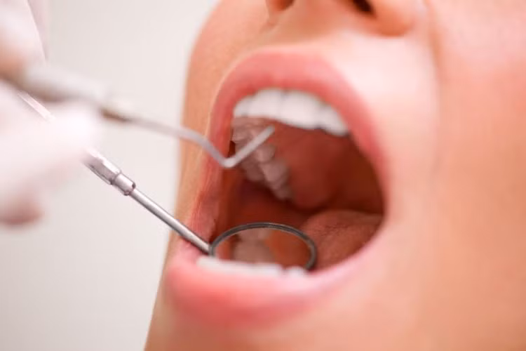 Vi khuẩn đường miệng gây bệnh huyết áp