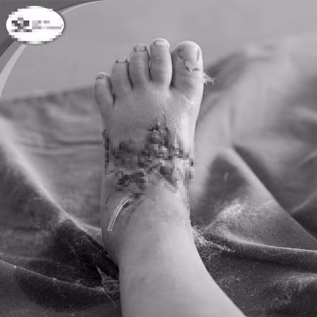 Bàn chân phải của trẻ bị dập nát. Ảnh: Lê Hiếu.