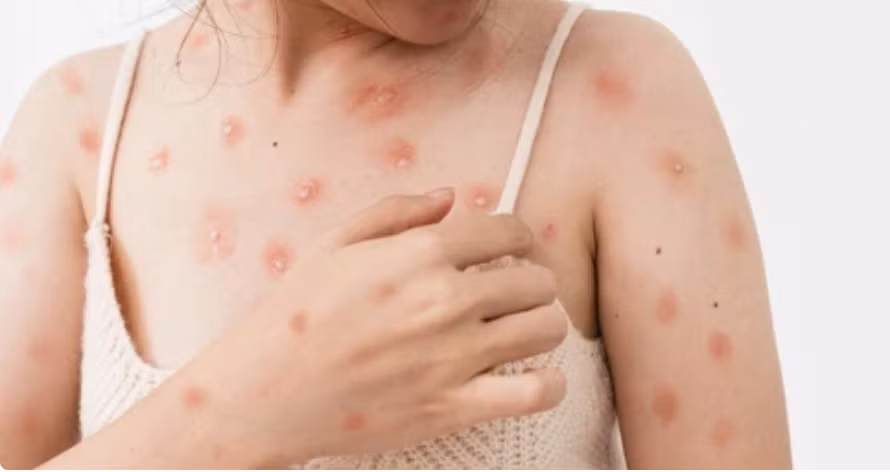 Nốt phỏng biểu hiện của bệnh đậu mùa khỉ. Ảnh: SHUTTERSTOCK. Nốt phỏng biểu hiện của bệnh đậu mùa khỉ. Ảnh: SHUTTERSTOCK.