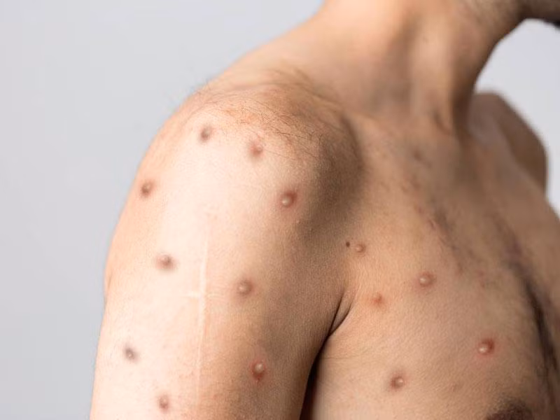 Không nên tiếp xúc trực tiếp với những vết thương của người mắc bệnh đậu mùa khỉ.