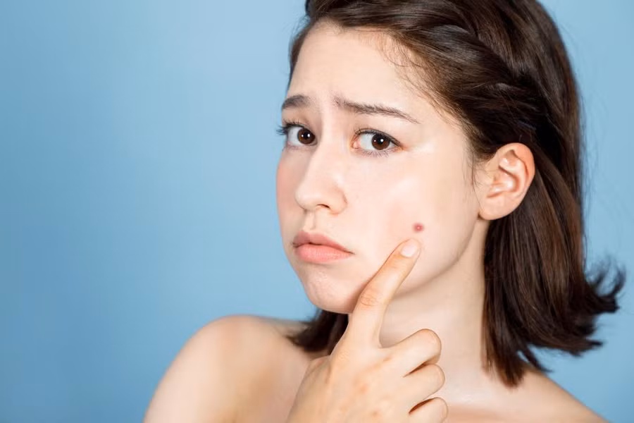 Mụn là hiện tượng thường gặp ở tuổi dậy thì, do sự thay đổi nội tiết tố, do chế độ ăn uống hoặc do không làm sạch da đúng cách.