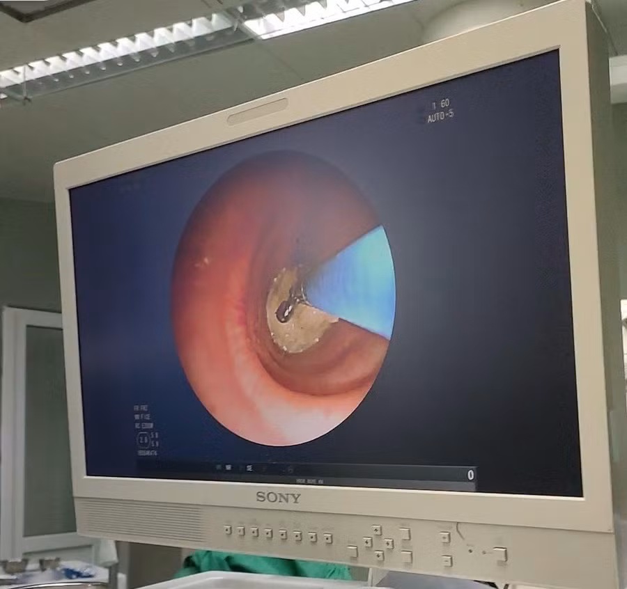 Hình ảnh dị vật gây bít tắc lòng phế quản của bệnh nhân. Ảnh: BV. Hình ảnh dị vật gây bít tắc lòng phế quản của bệnh nhân. Ảnh: BV.