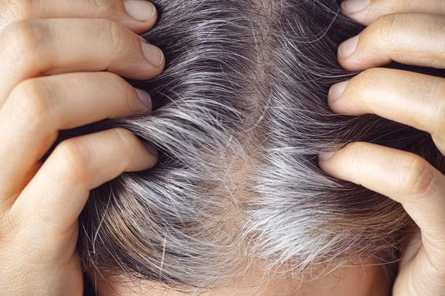 Có nhiều nguyên nhân gây bạc tóc sớm. Có nhiều nguyên nhân gây bạc tóc sớm.