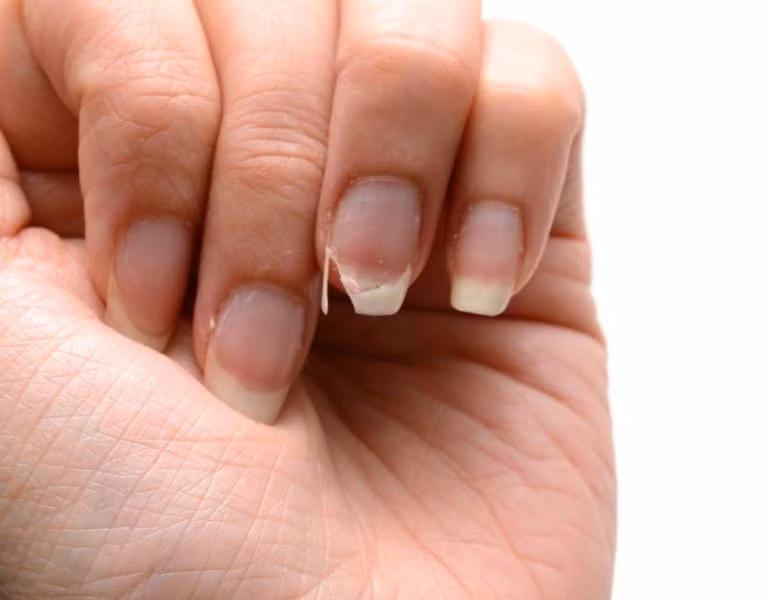 Móng giòn, dễ gãy báo hiệu cơ thể thiếu chất sắt (Fe).
