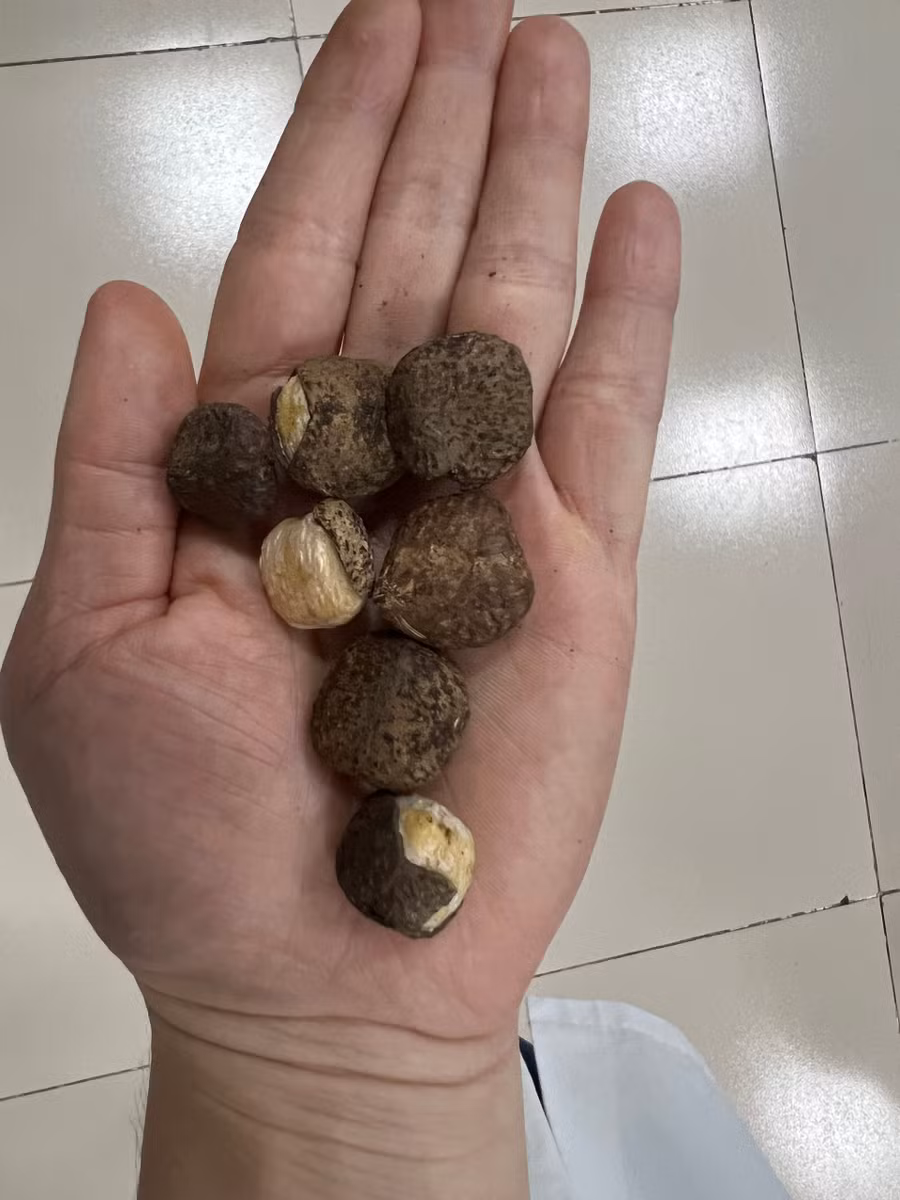 Loại hạt gây ra tình trạng ngộ độc của bệnh nhân. Ảnh: BVCC.