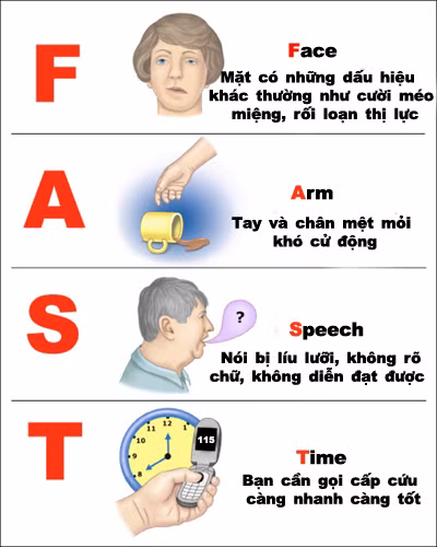 Biến chứng nặng vì hiểu sai về đột quỵ, cảnh báo sai lầm cần bỏ ngay ảnh 1