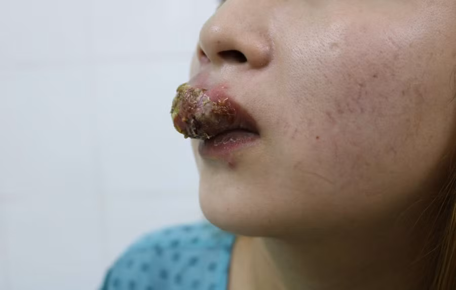 Sau xăm một tuần, môi dưới của chị T. bỗng nhiên nổi mụn, hôm sau môi trên cũng xuất hiện nhiều nốt mụn mủ sưng to. Ảnh: Kim Vân.