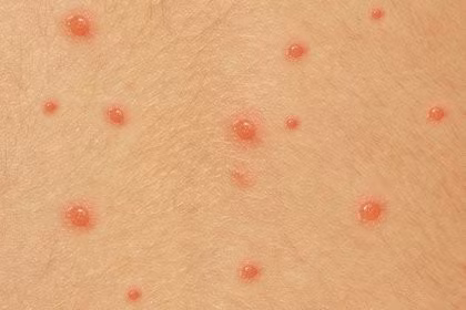 Người bị bệnh thủy đậu có thể mọc khoảng 100 - 500 nốt. Ảnh minh họa.