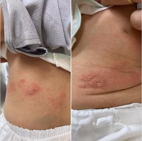 Một trường hợp 5 tháng tuổi mắc Zona hiếm gặp tại Bệnh viện Da liễu. Ảnh: BV. Một trường hợp 5 tháng tuổi mắc Zona hiếm gặp tại Bệnh viện Da liễu. Ảnh: BV.