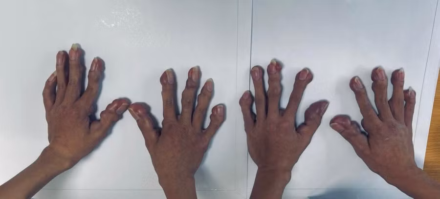 Các khối u trên cơ thể gây ảnh hưởng nhiều tới sức khỏe và sinh hoạt hàng ngày của anh em H và T. Ảnh: BV.