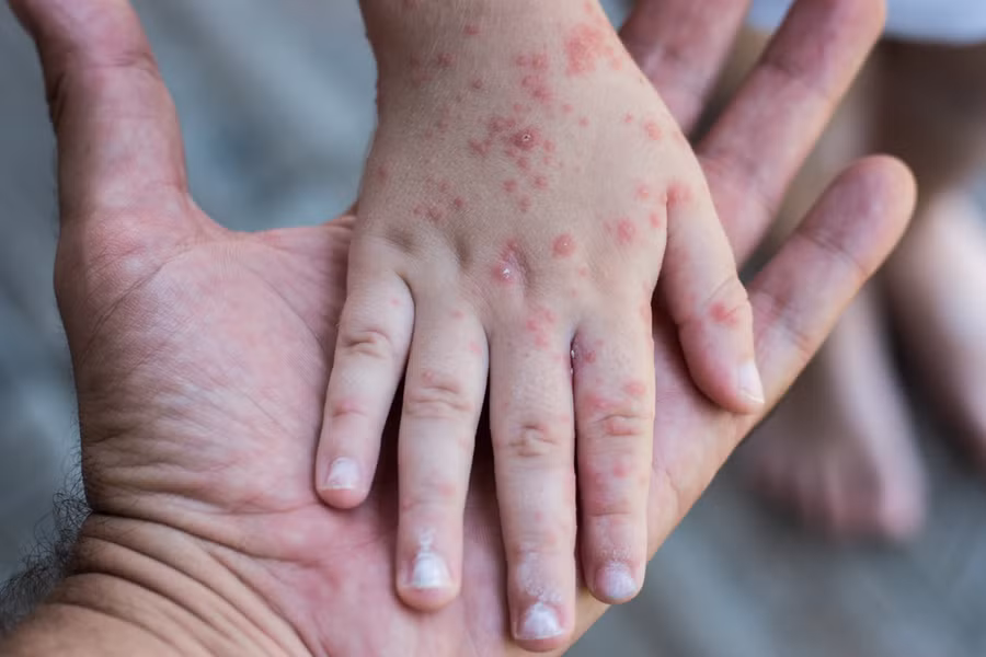 Bệnh rubella có các triệu chứng gồm sốt nhẹ, phát ban và viêm long nhẹ đường hô hấp, nổi hạch vùng cổ, chấm sau tai. Ảnh minh họa